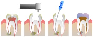 Šaknies kanalo gydymas yra galima dantų rovimo alternatyva
