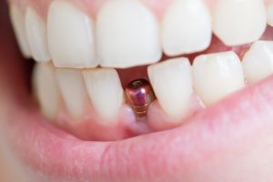 Apsvarstykite galimybę pakeisti trūkstamą dantį implantu