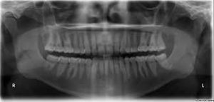 Rentgeno nuotrauka parodys dabartinę jūsų dantų ir žandikaulio būklę