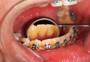 Pacientas tinkamai nesivalė dantų, kol nešiojo dantų kabes dabar atsirado gingvitas
