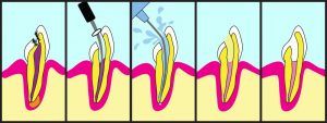 endodontija dantų kanalų gydymas
