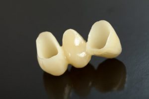 Trijų elementų keramikinis dantų tiltelis