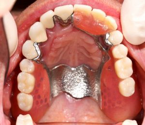 Viršutinis metalinis protezas, įtaisytas burnoje