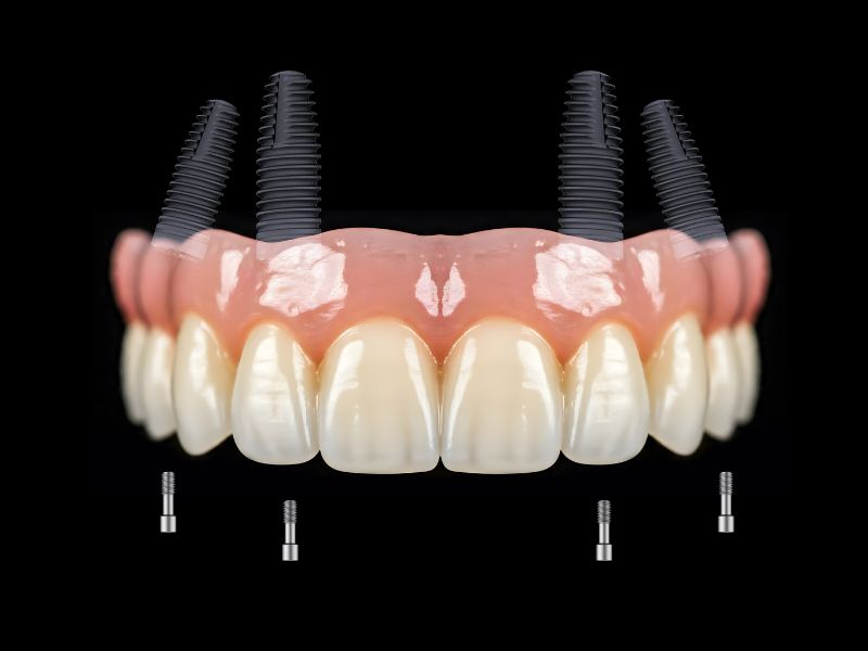 Bedančių žandikaulių atkūrimas metodu „Visi ant 4“