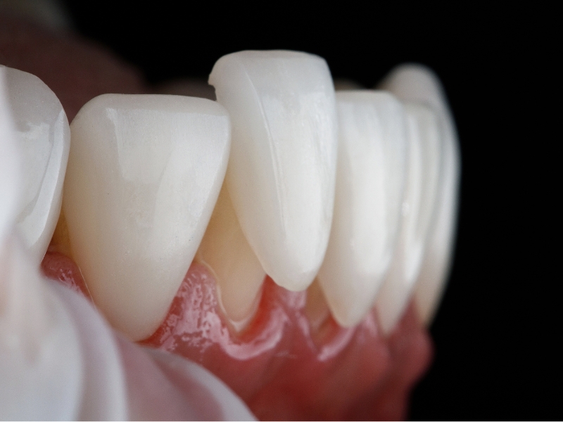 Dantų atkūrimas laminatėmis