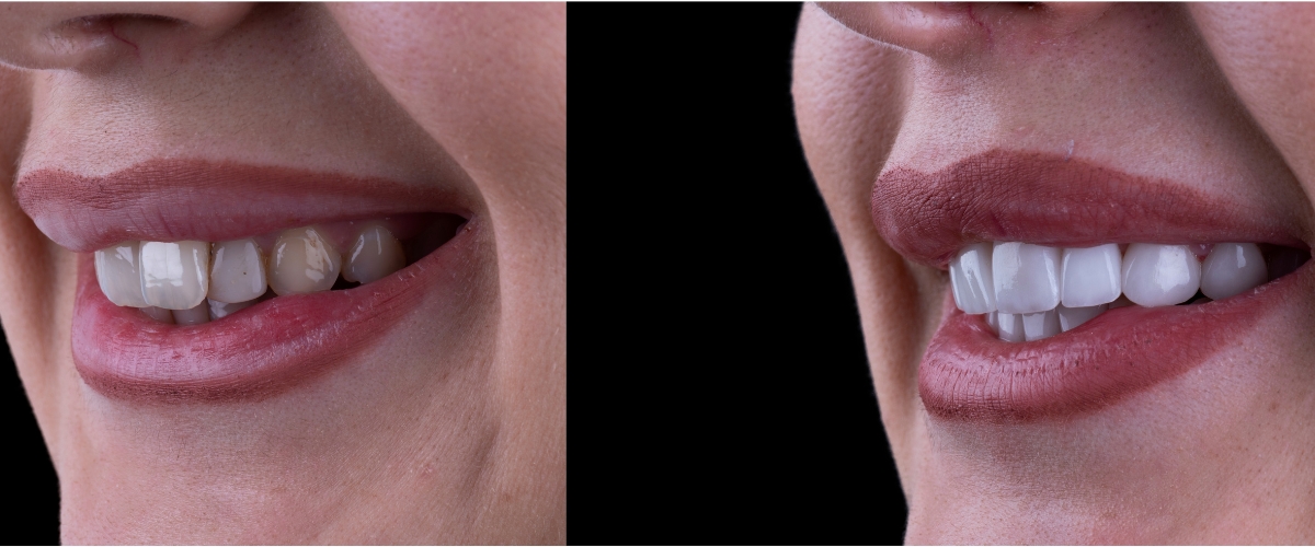 Kam skirtas dantų atkūrimas laminatėmis?