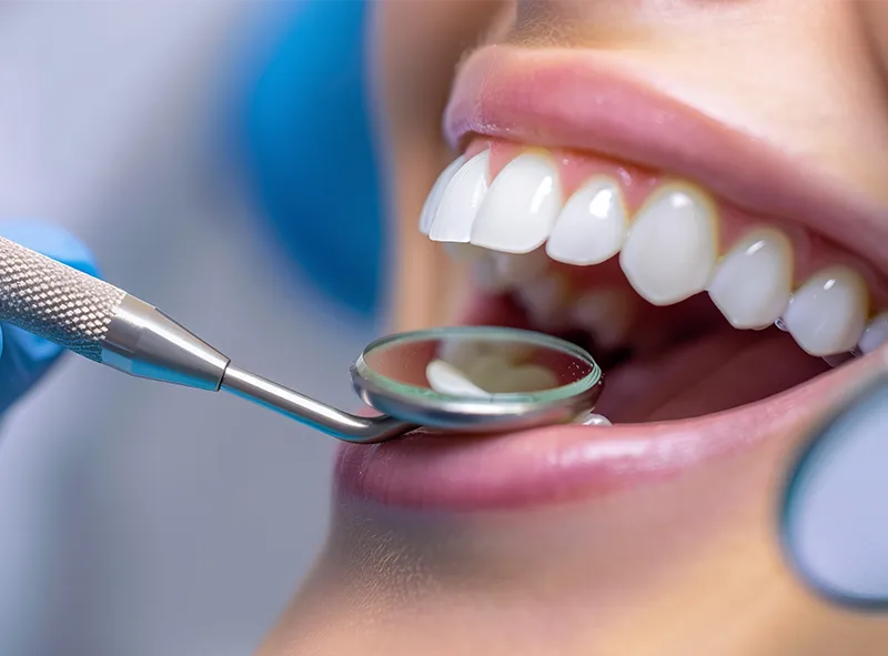 Profesionali burnos higiena