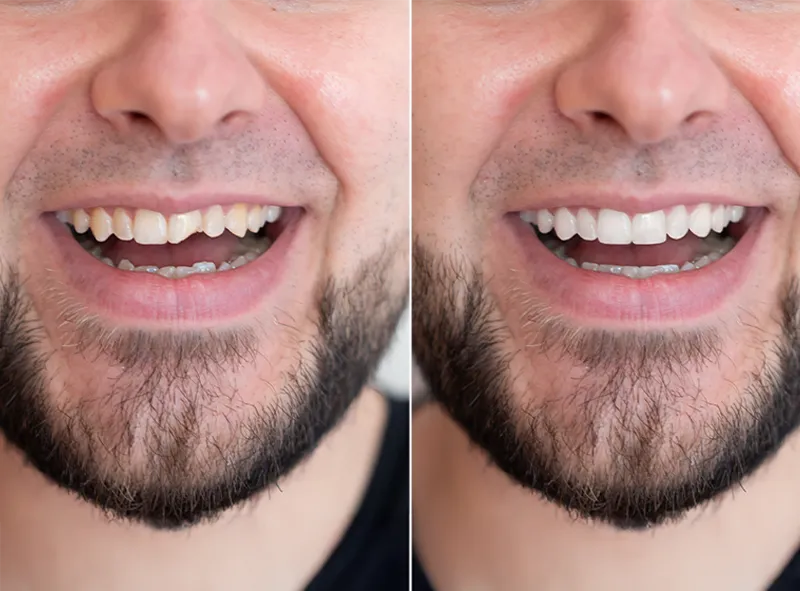 Estetinis plombavimas