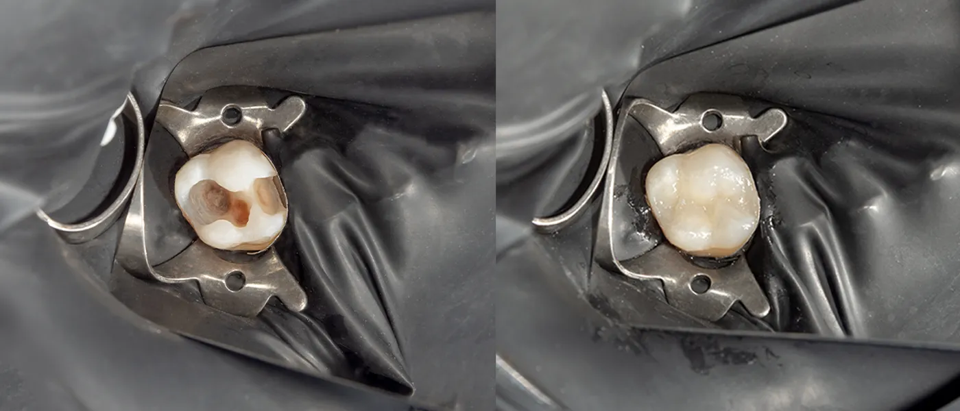 Kaip prižiūrėti dantis po atlikto dantų plombavimo?